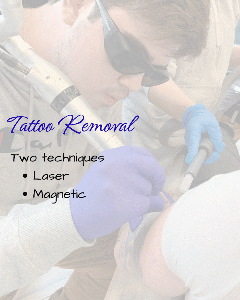 Tattoo Removal