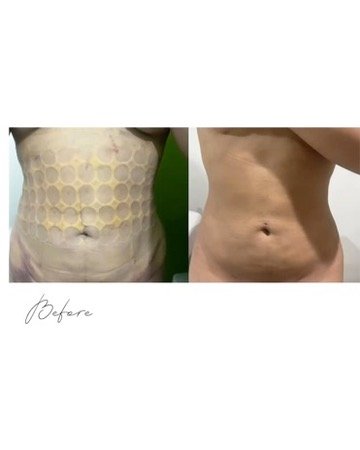 before and after gloria spa