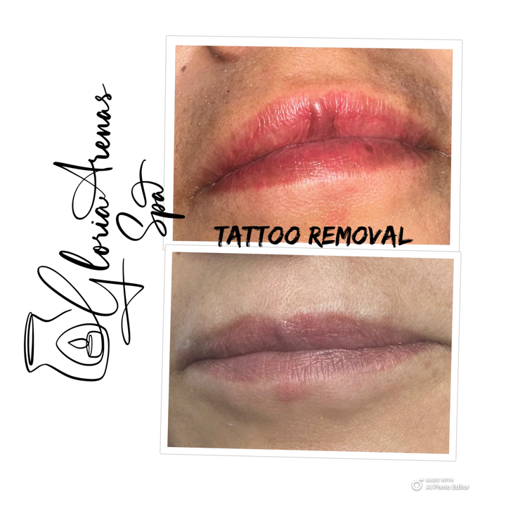 magnetic tattoo removal