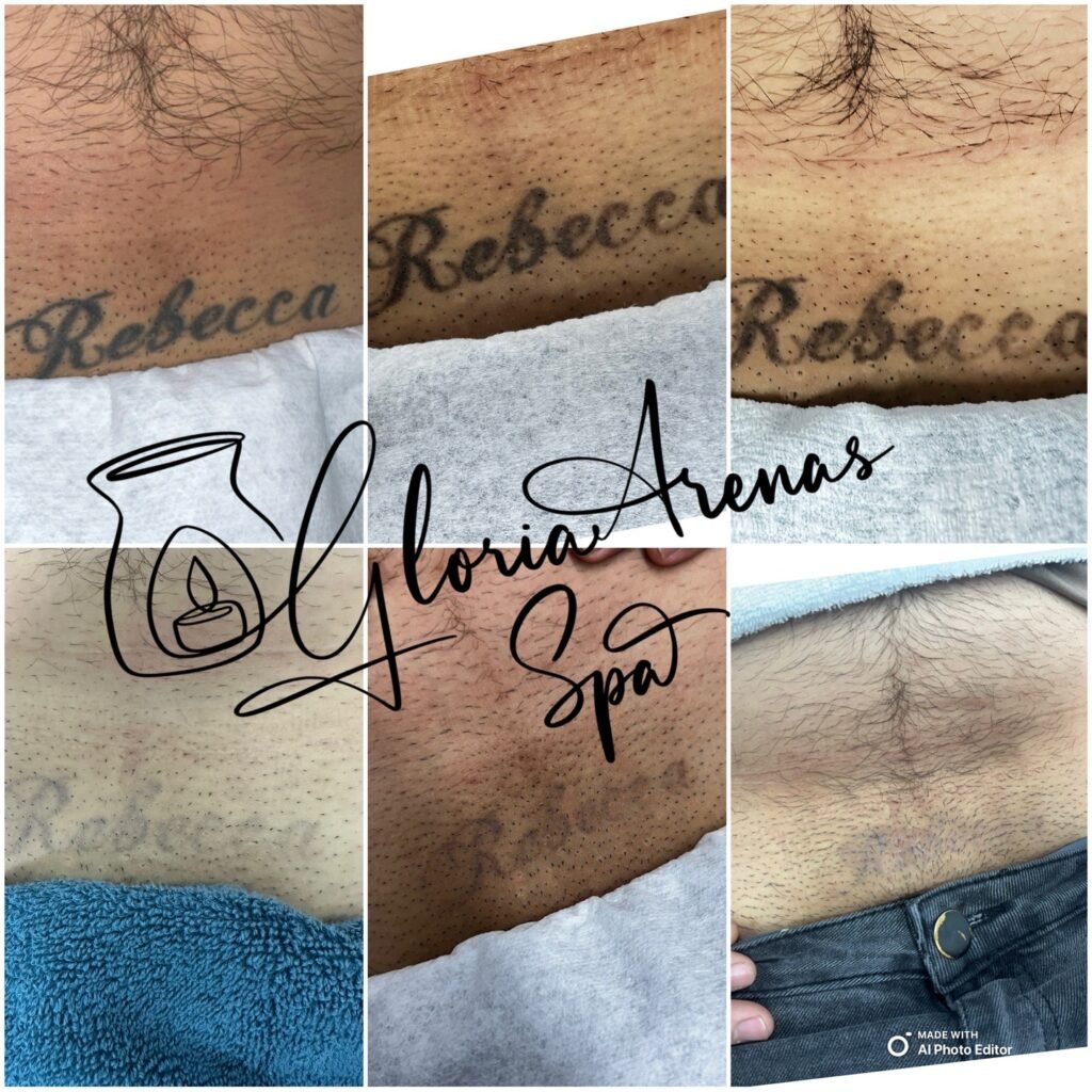 tattoo removal