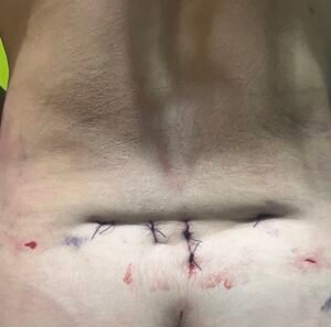 El Peligro del “Drenaje Abierto”