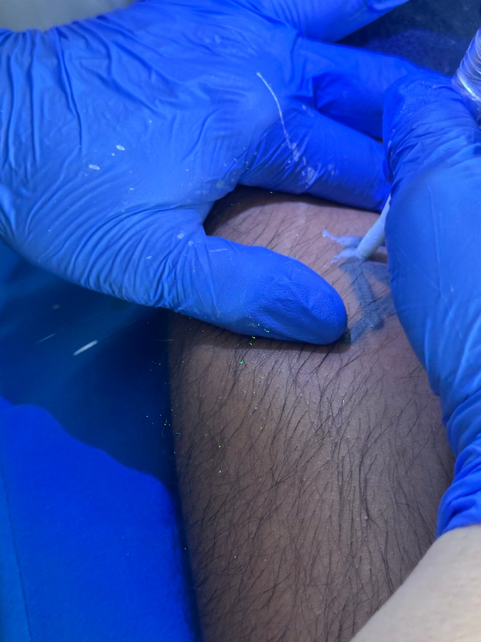 magnetic tattoo removal