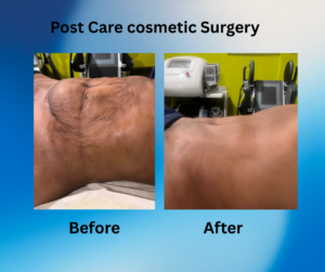 post care Lipo 360