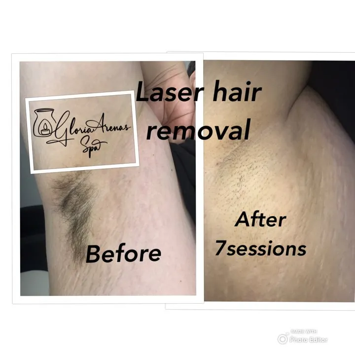 laser hair removal